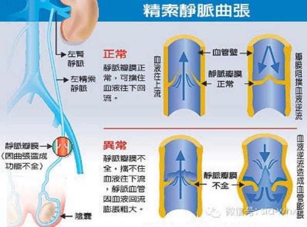 關(guān)于2021年征兵精索靜脈曲張標(biāo)準(zhǔn)的探討，2021年征兵精索靜脈曲張標(biāo)準(zhǔn)深度解析