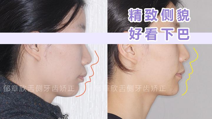 下巴后縮矯正方法詳解，下巴后縮矯正方法全面解析