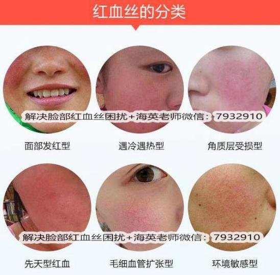 臉上出現(xiàn)紅血絲怎么治療，全面解析有效方法，臉上紅血絲全面解析與有效治療方法
