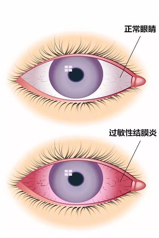 過敏性結膜炎，癥狀、原因及防治策略，過敏性結膜炎詳解，癥狀、成因與防治策略