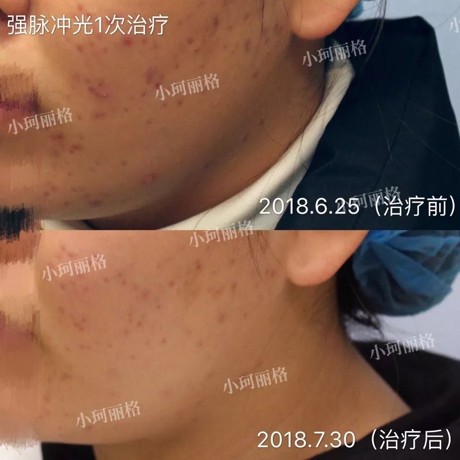 粉刺痤瘡怎樣徹底治愈，全面解析與有效方法，粉刺痤瘡全面解析，如何徹底治愈與有效防治方法