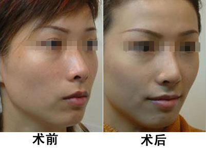 光子嫩膚做一次有效嗎？深入了解光子嫩膚的效果與過(guò)程，光子嫩膚效果與過(guò)程解析，做一次是否有效？