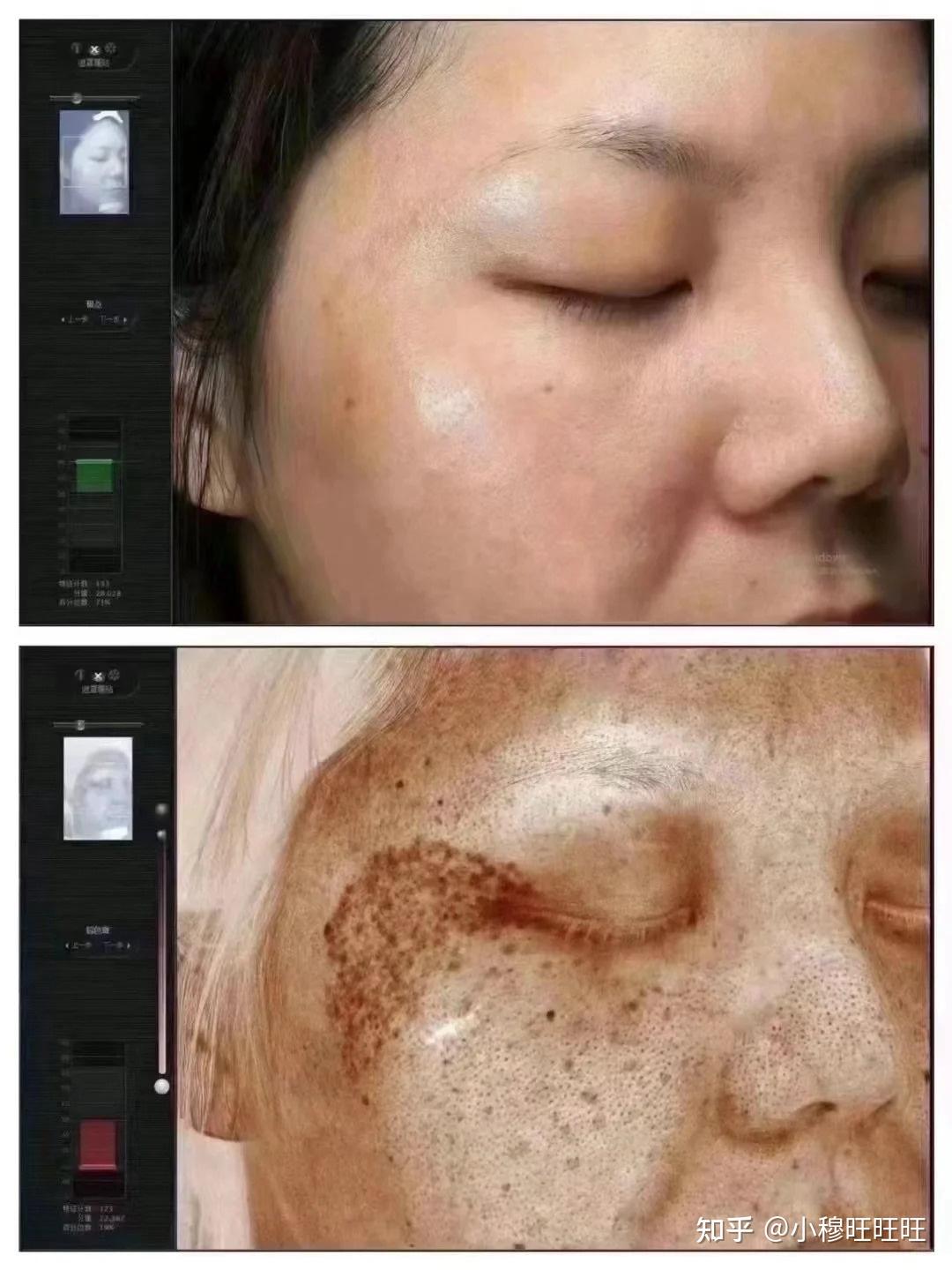 激光祛斑，選擇醫(yī)院還是美容院？全面解讀助您做出明智決策，激光祛斑，如何選擇醫(yī)院與美容院？全面解讀為您指明決策方向
