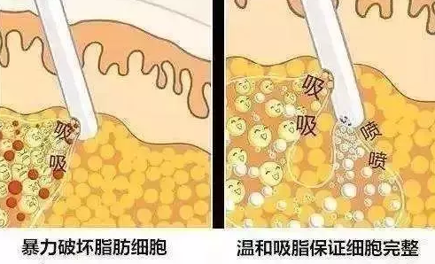 腹部吸脂肪大概需要多少錢——全面了解腹部吸脂手術(shù)費(fèi)用，腹部吸脂手術(shù)費(fèi)用全面解析，了解腹部吸脂肪所需大致費(fèi)用