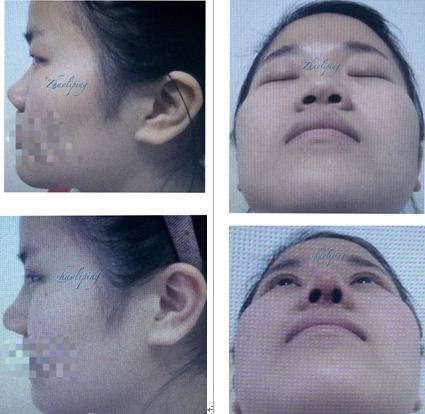 鼻頭縮小整形價格詳解，因素、費用及注意事項，鼻頭縮小整形價格解析，費用、因素與注意事項全指南