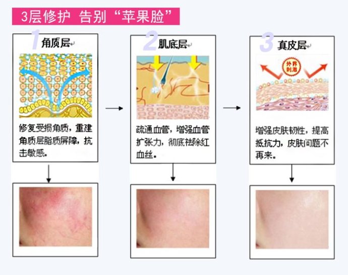 治療紅血絲的最佳方法，治療紅血絲的最佳方法簡(jiǎn)述