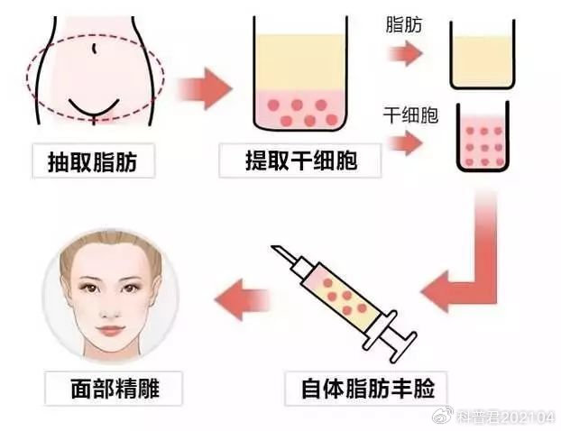 面部脂肪填充效果持久性解析，能保持幾年？，面部脂肪填充效果的持久性解析，能維持多少年？