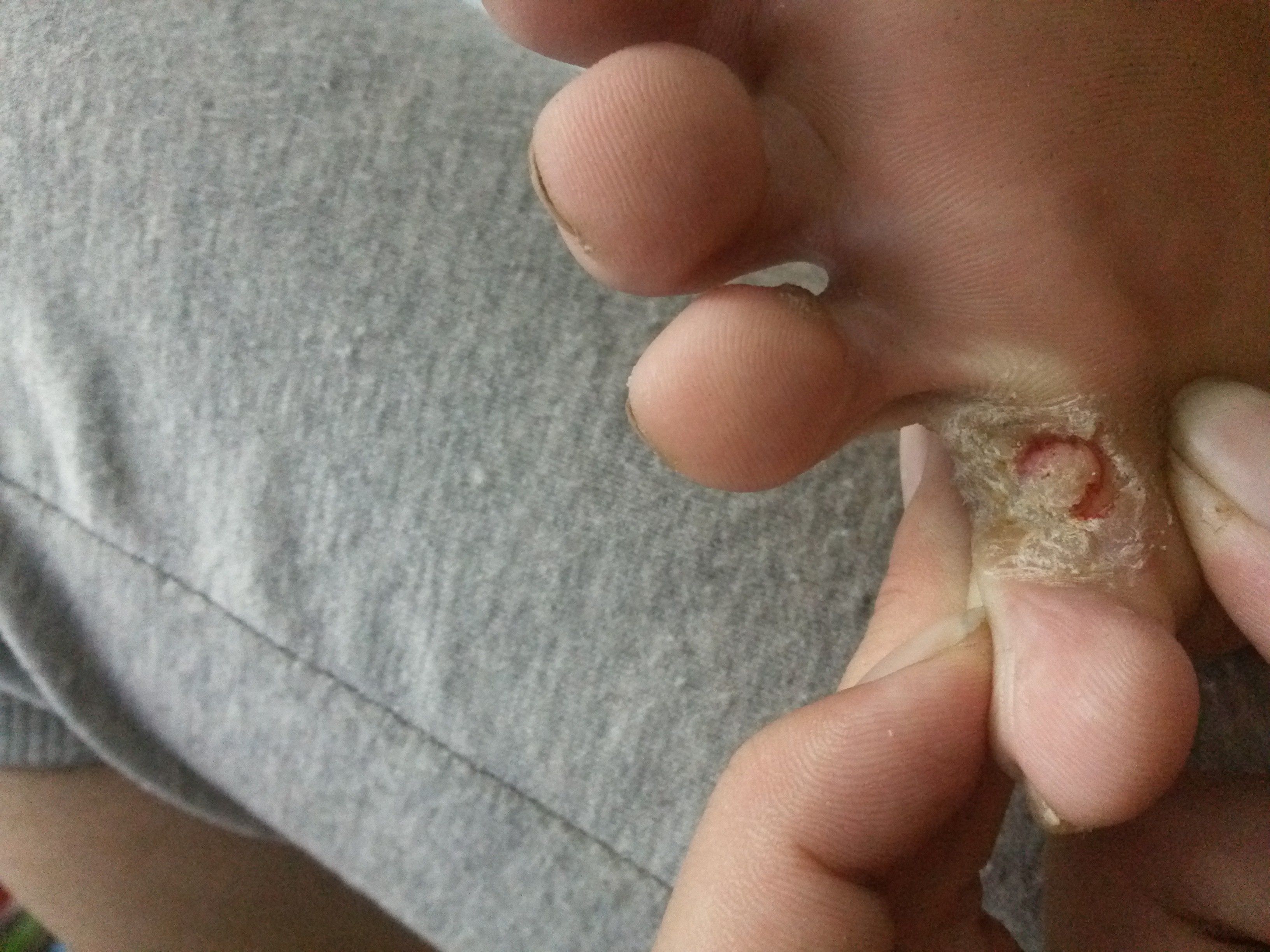 腳上怎么分辨是濕疹還是腳氣——一篇文章帶你了解二者的區(qū)別，腳上濕疹與腳氣如何區(qū)分？一篇文章詳解二者區(qū)別。