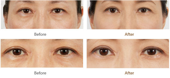 去眼袋手術全過程視頻解析，去眼袋手術全過程詳解視頻指南