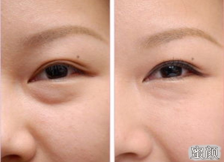 如何消除眼袋，簡單實用的方法，消除眼袋的實用方法與技巧