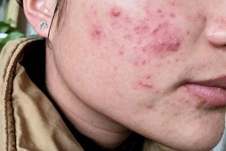 臉上痤瘡的癥狀和圖片，全面解析與識(shí)別指南，全面解析與識(shí)別，臉上痤瘡的癥狀和圖片指南