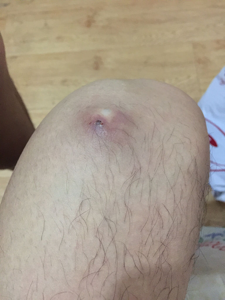 痘痘長不出來，肉里硬硬的，原因解析與應對建議，痘痘無法冒出表面，內部硬結成因解析及應對之策