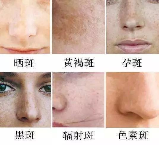 如何有效去除臉上斑點(diǎn)——全方位指南，全方位指南，如何有效去除臉上斑點(diǎn)