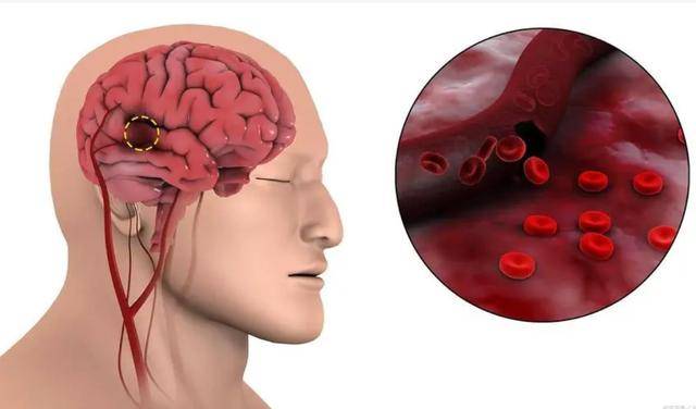如何判斷自己是否腦供血不足——癥狀解析與應(yīng)對策略，腦供血不足的判斷方法，癥狀解析及應(yīng)對之策